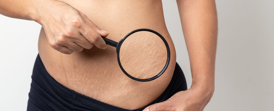How to Get Rid of Stretch Marks After Pregnancy?